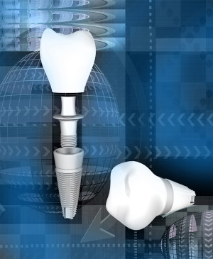 Les implants